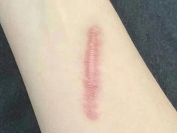 Hypertrophy Scar After Trauma Henan Biocontec Medical Co Ltd