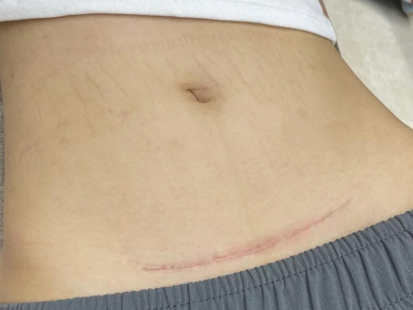 Linear Hypertrophic Scar After C Section Surgery Henan Biocontec Medical Co Ltd